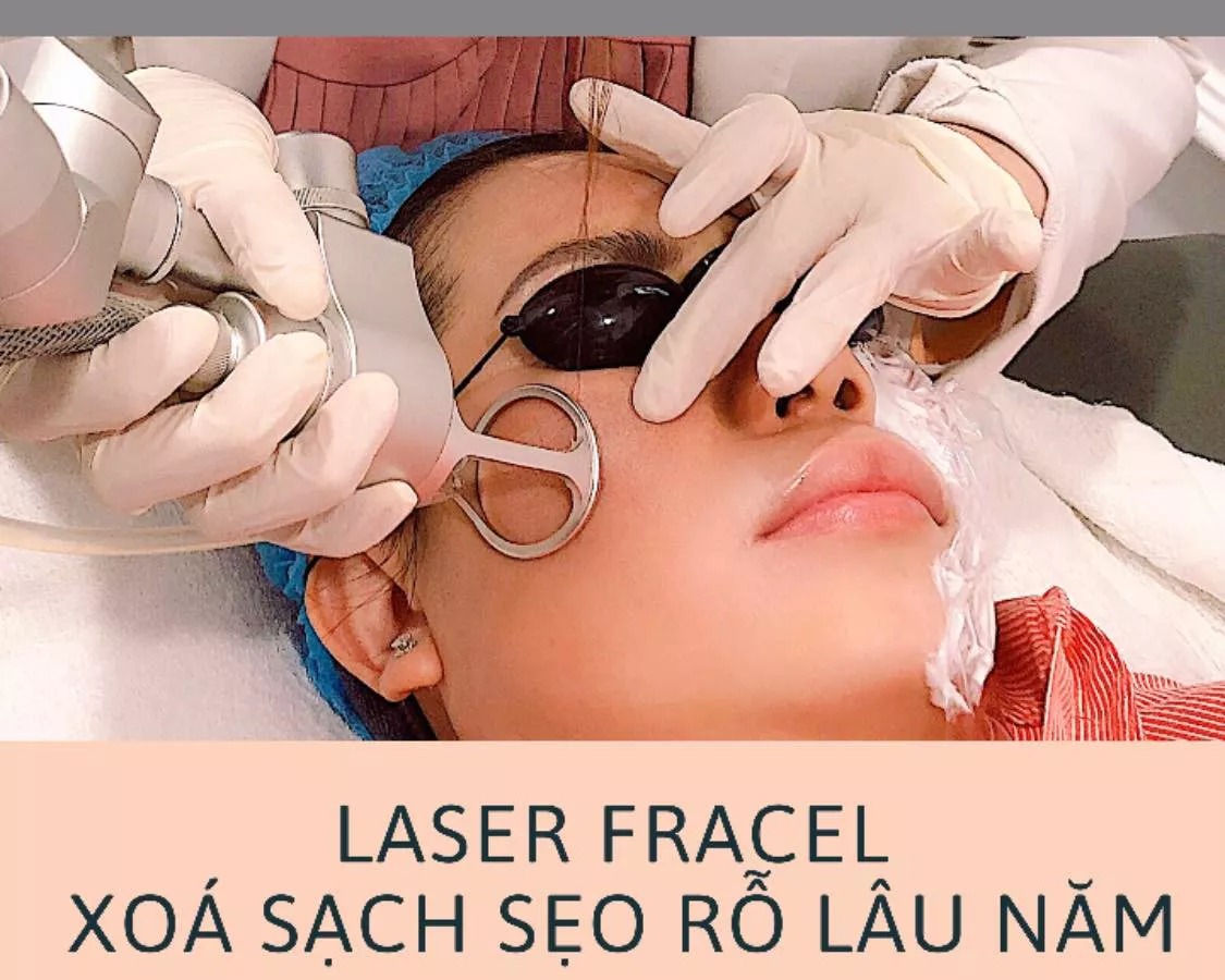 Super Scar Hill: Công Nghệ Trị Sẹo Rỗ Độc Quyền Xóa Bỏ Nỗi Lo Sẹo Lâu Năm